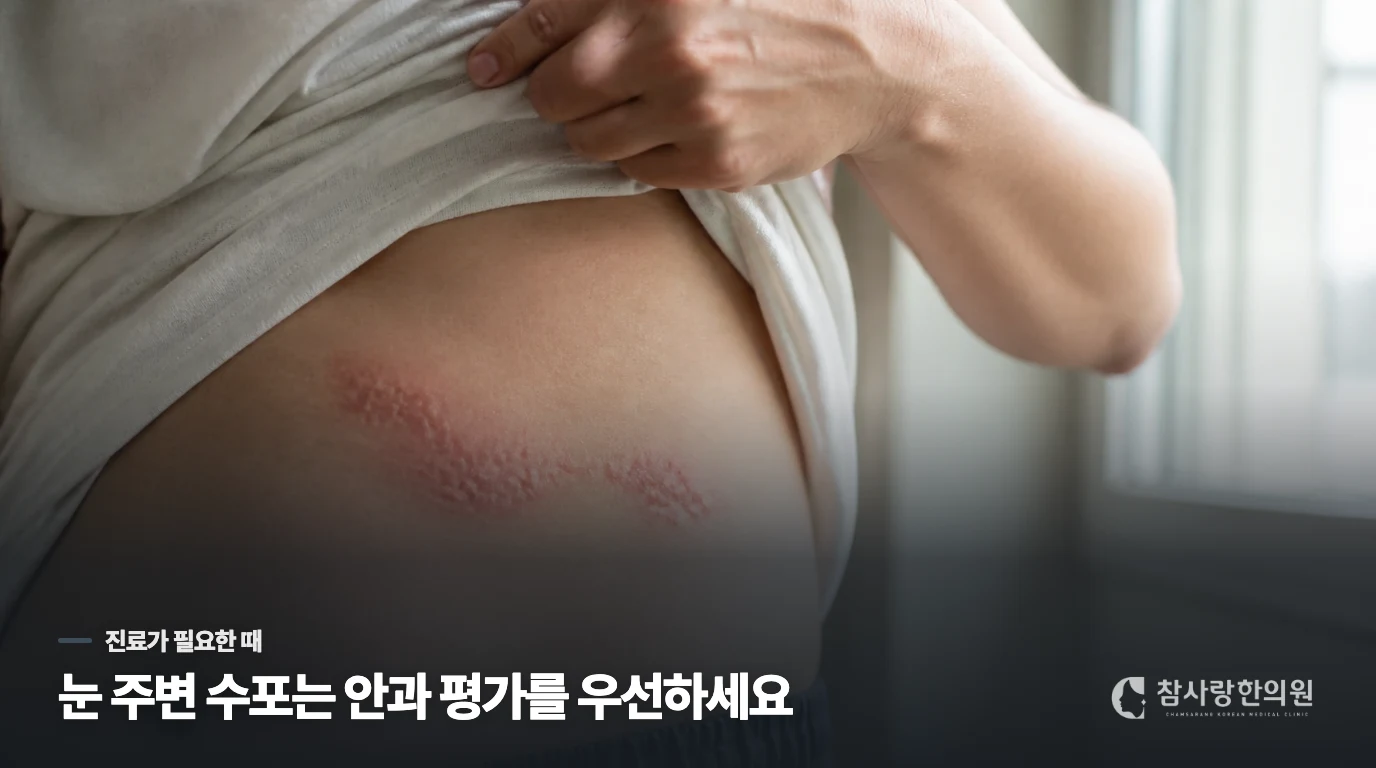 새 수포가 생겼다면 72시간 안에 치료 시점을 놓치지 마세요